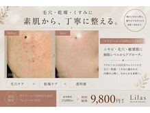 リラ 郡山店(Lilas)の雰囲気（ニキビ/毛穴ケアして肌質改善♪ララピール×OMEGA PDTで最新美容）