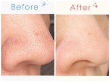 ジェシカ 荻窪店/荻窪/毛穴洗浄☆