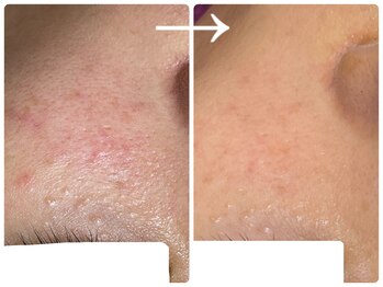 フォーチューン/ハーブトリートメント