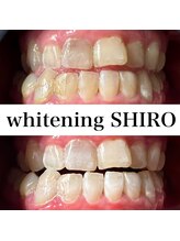 福岡ホワイトニングシロ 天神中洲店(福岡ホワイトニングSHIRO)/【ホワイトニング】before/after