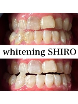 福岡ホワイトニングシロ 天神中洲店(福岡ホワイトニングSHIRO)/【ホワイトニング】before/after