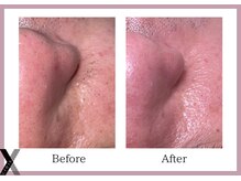 クロス(Xcross)/毛穴ケア【毛穴/代官山/渋谷】