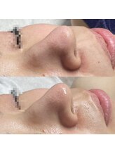 ジョンミー(JONMEE)/毛穴洗浄で毛穴のお掃除！