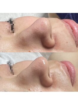 ジョンミー(JONMEE)/毛穴洗浄で毛穴のお掃除!