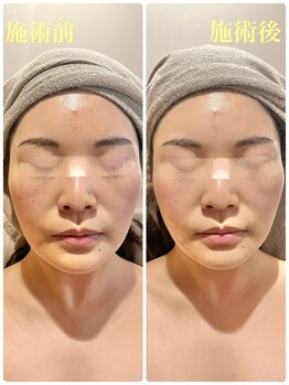 ルネ(Lune)/MTメタトロンの引き上げ効果