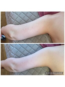 アクアモア/アクアモアの痩身★BeforeAfter