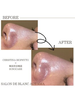 サロン ド ブラン アオヤマ(Salon de BLANC AOYAMA)/毛穴悩みはハーブピーリング!