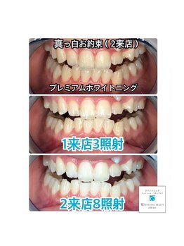 ホワイトニングビューティー 吉祥寺店/症例写真_2回来店されたお客様