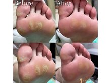 巻き爪補正店 豊田店/【肩いタコ/魚の目ケア】