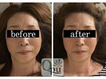 キュープ 鹿児島伊集院店(Qpu)/お顔全体が引き上がりスッキリ♪