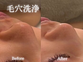 アールエーサロン 恵比寿 広尾(Ra salon)/毛穴洗浄1回での変化