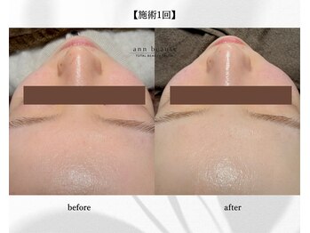 アン ビューティー(ann beauty)/施術1回【症例写真】30代