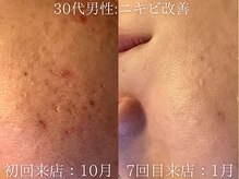 ブリエ(Briller)/３０代男性ニキビ改善