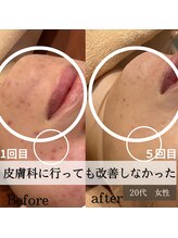 パルティノ 高崎店/自分のケアではもう限界