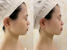 ナラビューティー(NARA BEAUTY)/輪郭リフト1回効果　小顔恵比寿