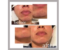 オークツリー(oak tree)/☆魅せる髭脱毛☆