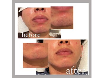 オークツリー(oak tree)/☆魅せる髭脱毛☆