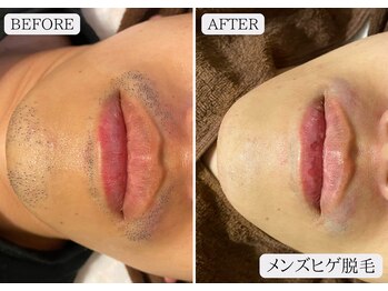 ルミア 函館店(LuMia)/清潔感が段違いのモテ肌へ☆