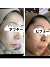 ココ 梅田中津(COCO.)/ニキビ　フェイシャル　