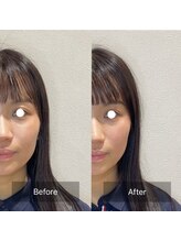 ウル(ulu)/むくみ、エラの張りには美容鍼