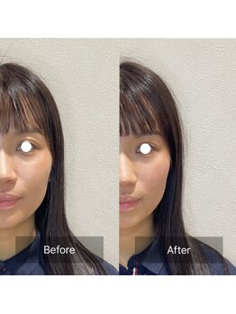 ウル(ulu)/むくみ、エラの張りには美容鍼