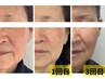 フェイシャル人気No1【たるみが気になる方】