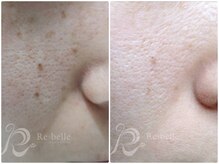 まいれ整骨院 大津市堅田院 マイレ 堅田店(MAILE)/シミケア・毛穴ケア