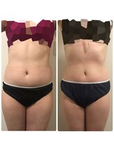 リボディ プラチナ(Rebody platinum)/ボディスカルプト×ボディケア