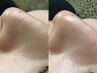 毛穴洗浄＋顔脱毛　▽毛穴汚れ・お顔の産毛を撃退◎