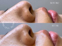 マリベル(MARIBEL)/鼻下ワックス脱毛