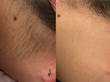 ビューティービレッジ(Beauty village)/自分では処理しにくいうなじ脱毛