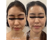 マハロヌイロア(mahalonuiloa)の雰囲気（ハイドロヴィーナス+ミコステラで艶肌◎毛穴レス！¥15,000）