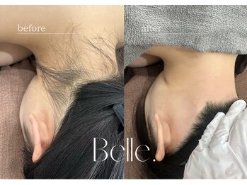 ベル(Belle)/【症例】骨格デザインうなじ脱毛