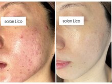 リコ(Lico)/ニキビケア