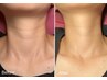 人気No.2【首までしっかりケア】シワたるみ徹底改善コース脂肪6cc ¥18,500