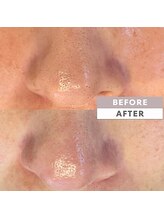 エムアンドユウ(m&u)/毛穴洗浄3階目のお客様