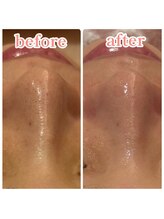 レティシア(Leticia)/◇肌管理フェイシャル◇毛穴洗浄