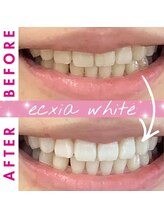 エクシアホワイトニング 西尾店/ビフォーアフター