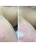 【新規女性/美容成分たっぷり内側から水光肌】フェイシャルワックス脱毛¥6980