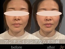 チョコバリ 恵比寿店(chocobari)/小顔リフトアップ（美容鍼）30代