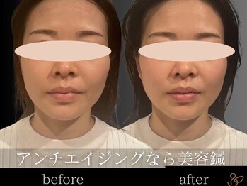 チョコバリ 恵比寿店(chocobari)/小顔リフトアップ（美容鍼）30代