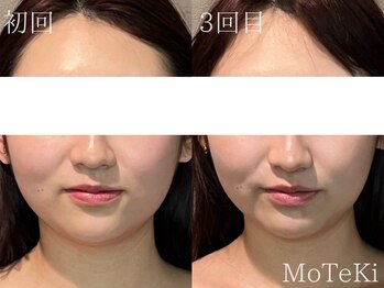 モテキ 表参道店(MoTeKi)/症例Befor/Afterカンナムリフト