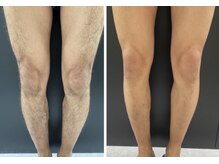 ザ ルード(ZA:RUDO)/メンズ脱毛～BODY～