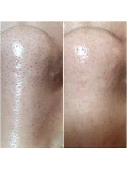 ゆるり/韓国式3D毛穴洗浄