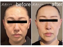 プチボヌール(petit bonheur)/光糸リフト