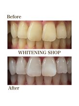 ホワイトニングショップ 恵比寿店/【Before　After】