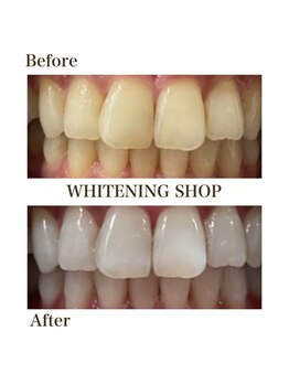 ホワイトニングショップ 恵比寿店/【Before After】