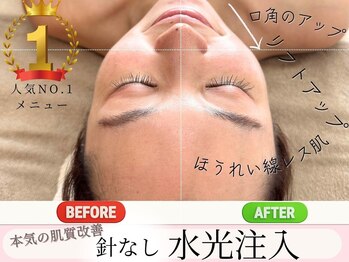 マヴィ 高槻店(MavY.)/最先端美容！針なし水光注入