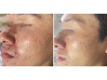 ルアナ(Luana)/【Before/after】フェイシャル