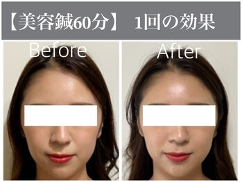 サンクエール 代官山鍼灸院(CINQ AILES)/美容鍼灸　浮腫み改善・小顔